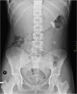 Radiograph from the case bank: Urinary tract calculi (kidney or ureteric stones)