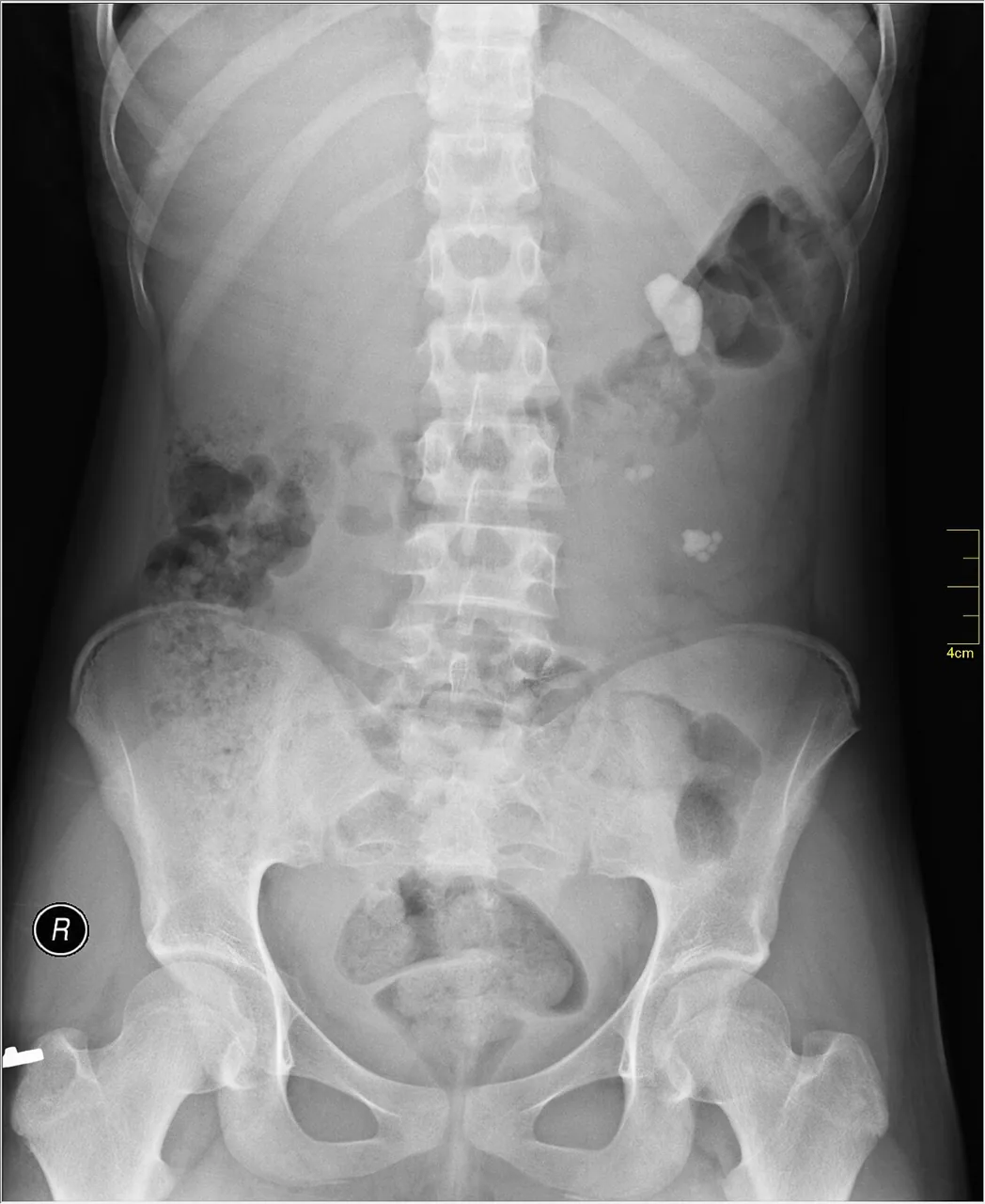 Abdomen radiograph for self-assessment
