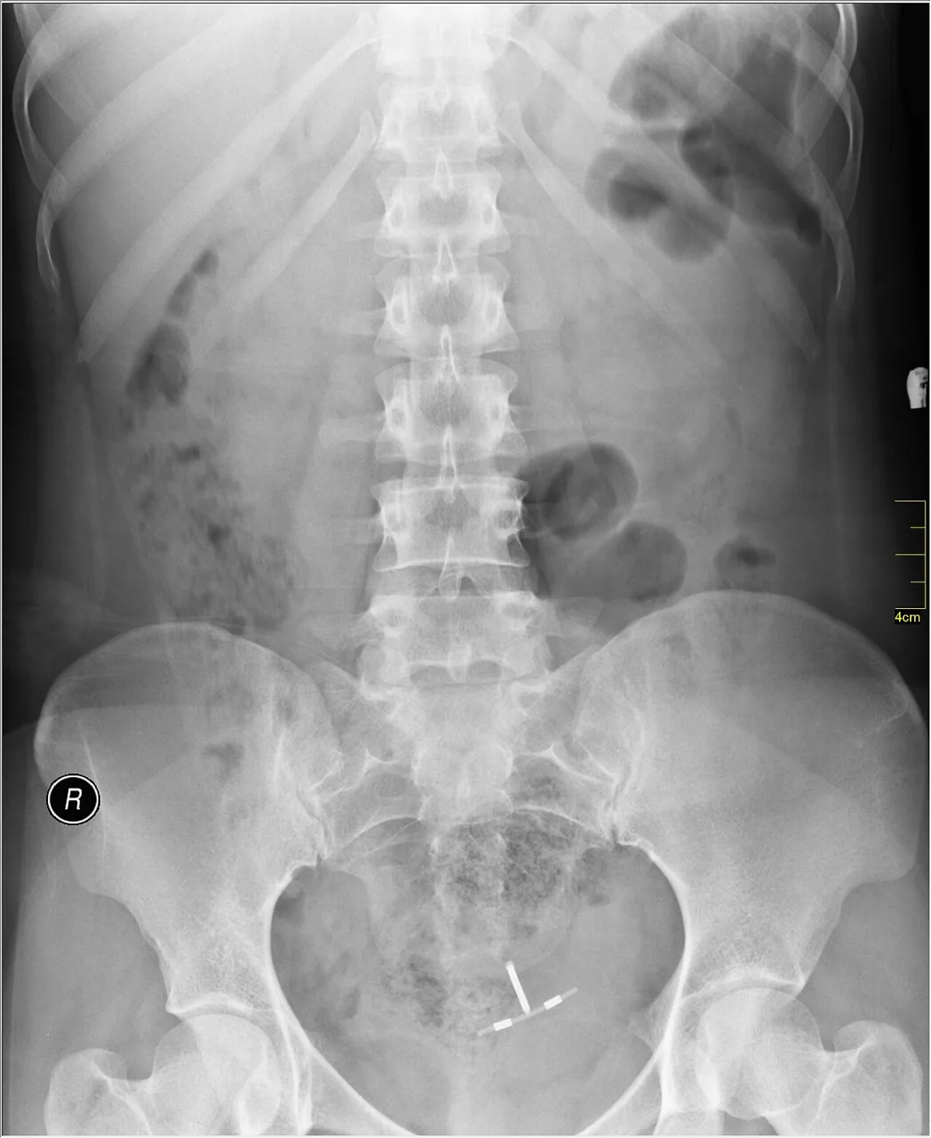 Abdomen radiograph for self-assessment