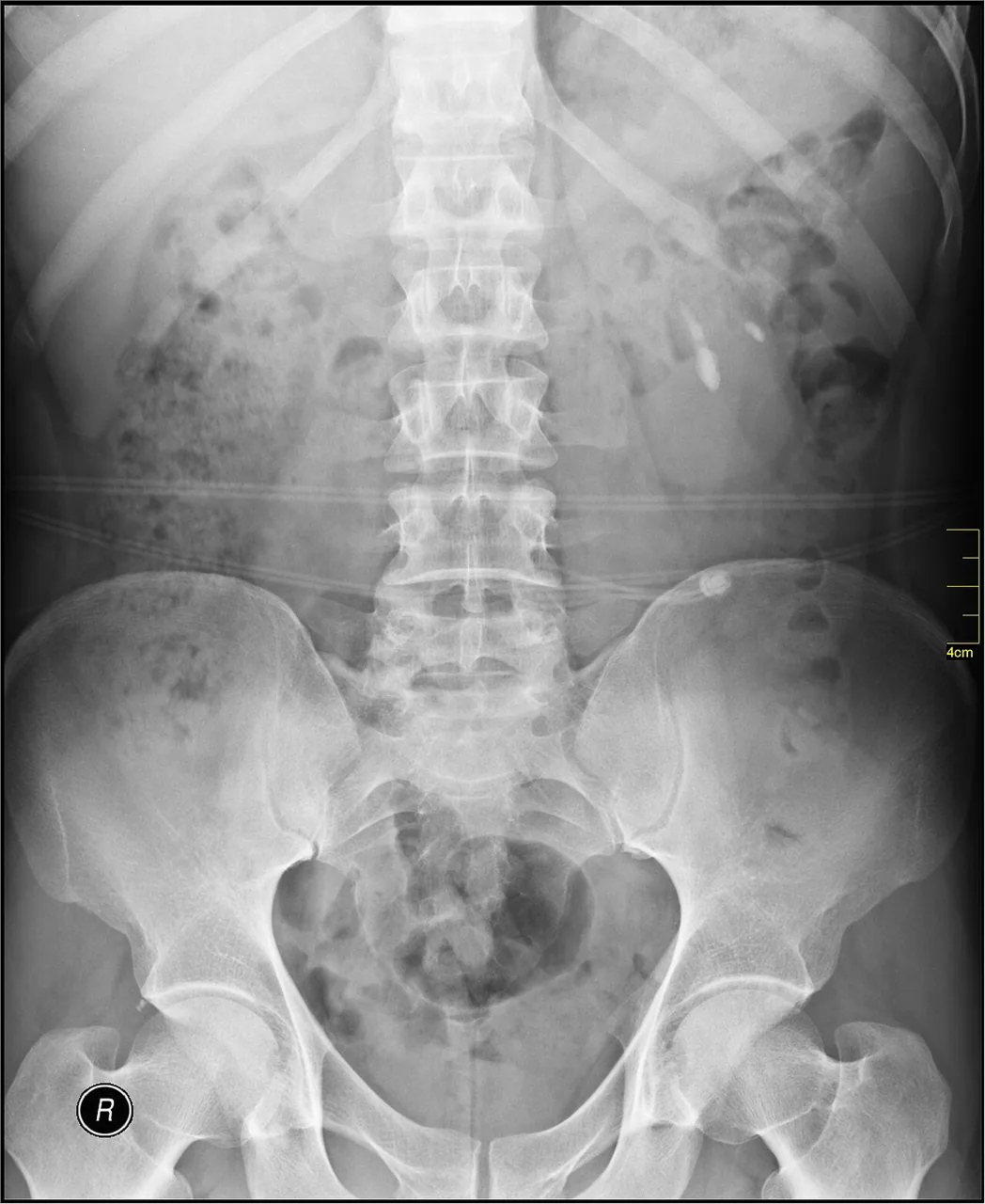 Abdomen radiograph for self-assessment