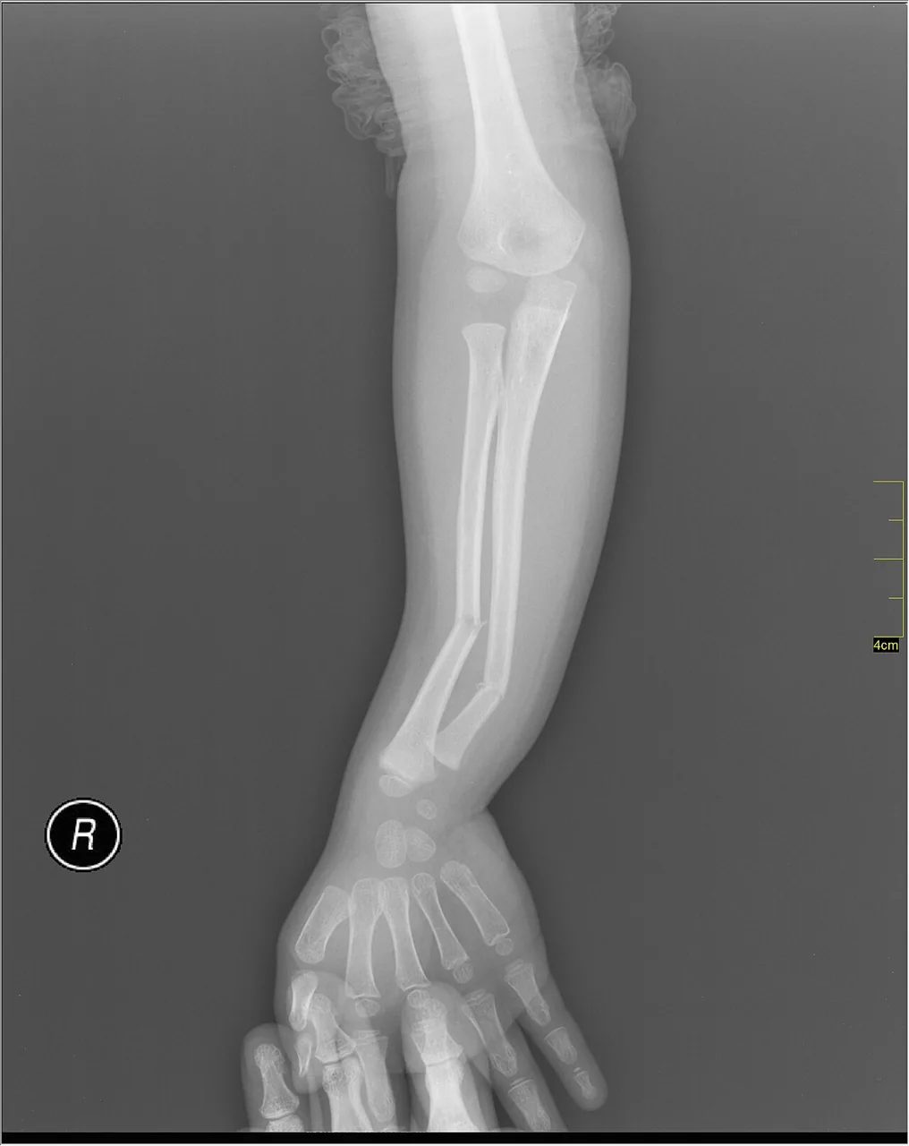 Upper limb radiograph for self-assessment