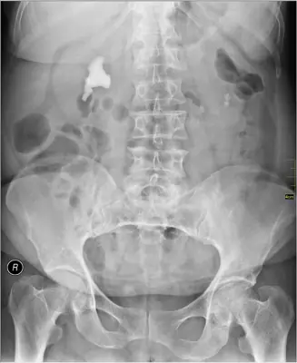 Radiograph from the case bank: Urinary tract calculi (kidney or ureteric stones)