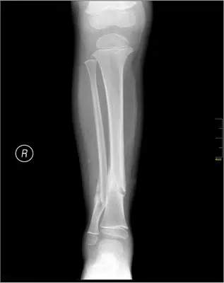 Radiograph from the case bank: Tibial (and fibular) shaft fracture