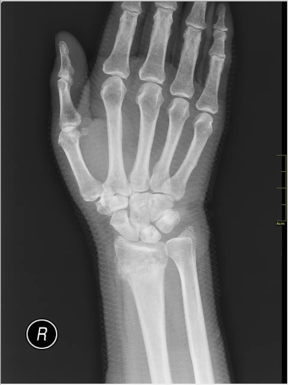 Upper limb radiograph for self-assessment