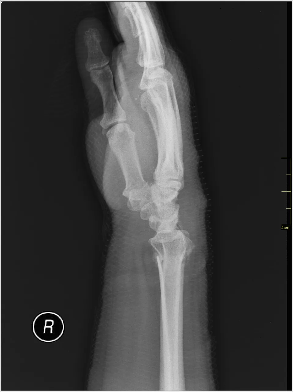 Upper limb radiograph for self-assessment