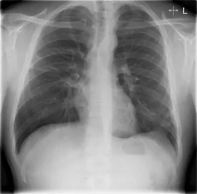 Radiograph from the case bank: Pneumonia (consolidation)