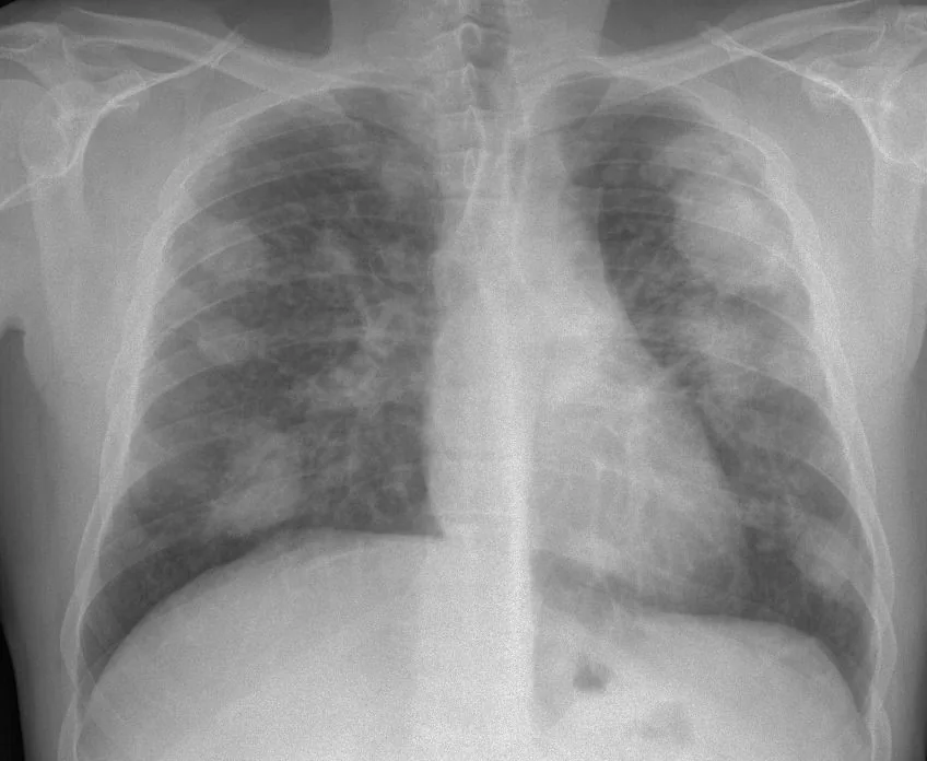 Chest radiograph for self-assessment