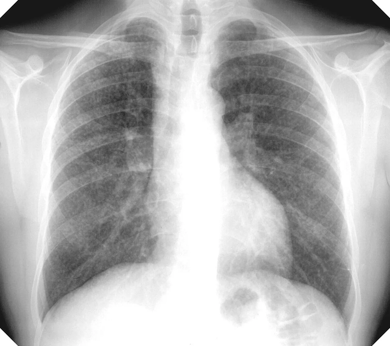 Chest radiograph for self-assessment
