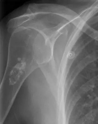 Radiograph from the case bank: Enchondroma