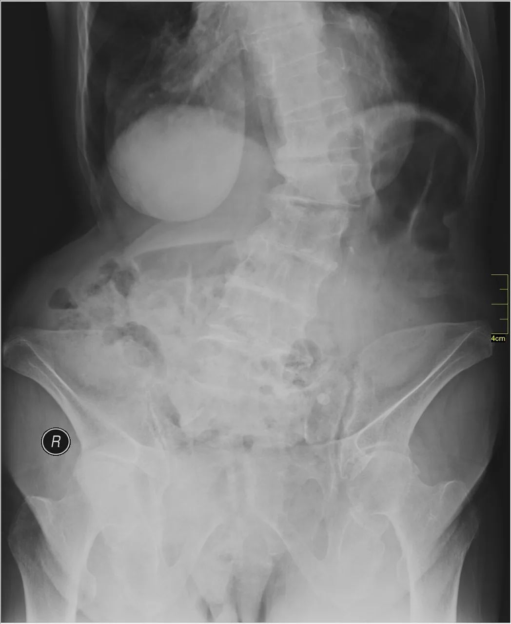 Spine radiograph for self-assessment