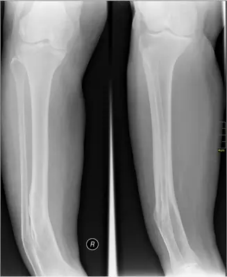 Radiograph from the case bank: Tibial (and fibular) shaft fracture