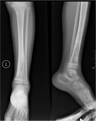 Radiograph from the case bank: Tibial (and fibular) shaft fracture