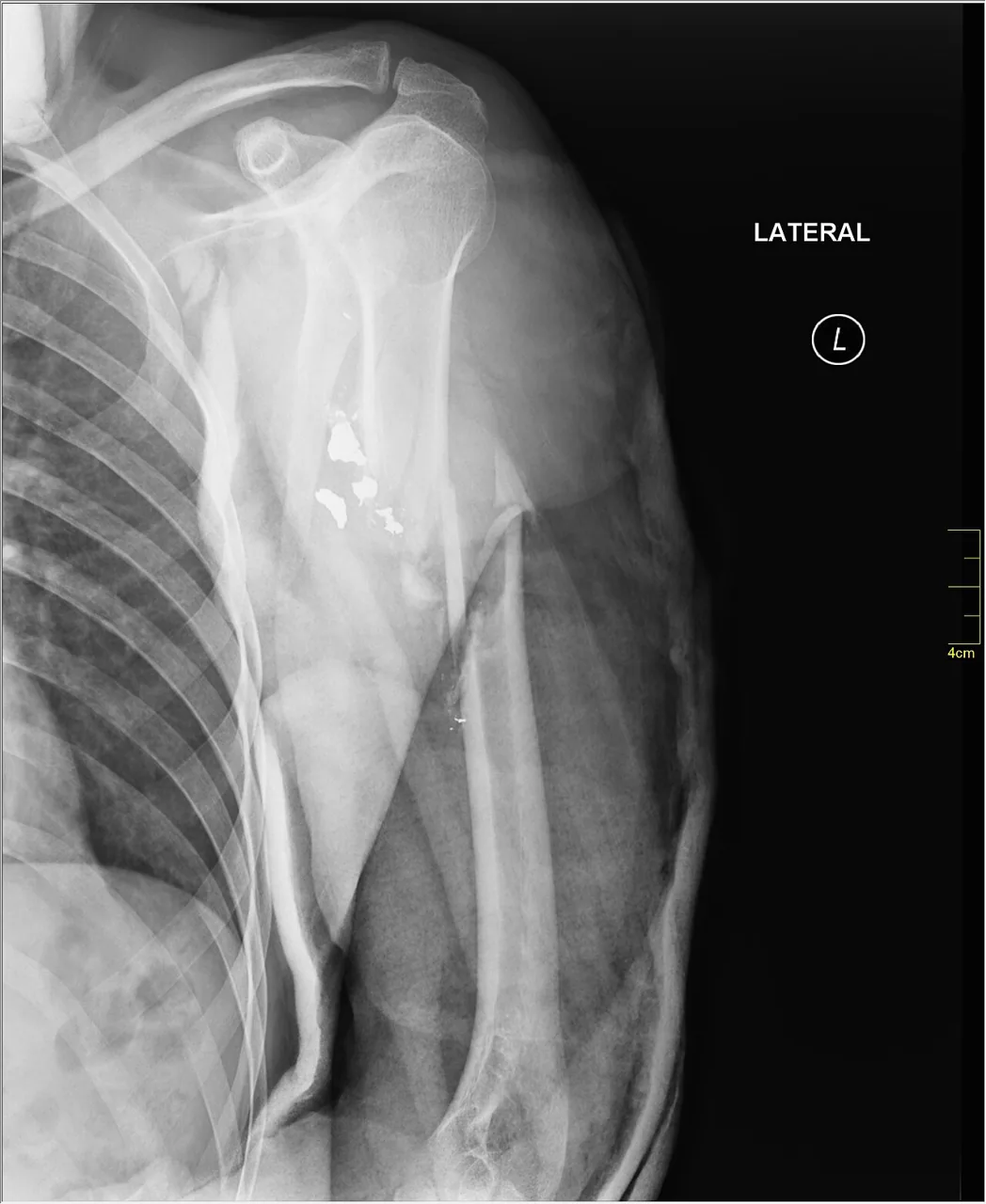 Upper limb radiograph for self-assessment