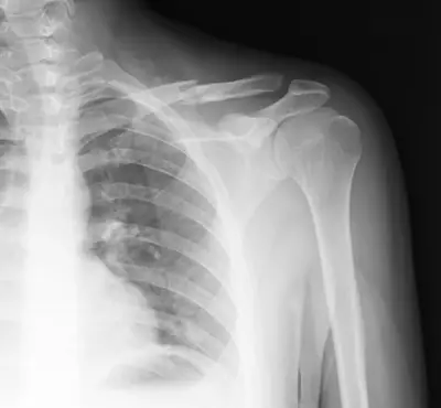 Radiograph from the case bank: Clavicle fracture