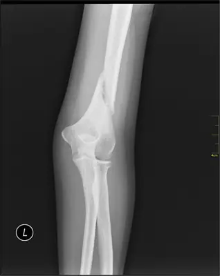 Radiograph from the case bank: Humeral shaft fracture