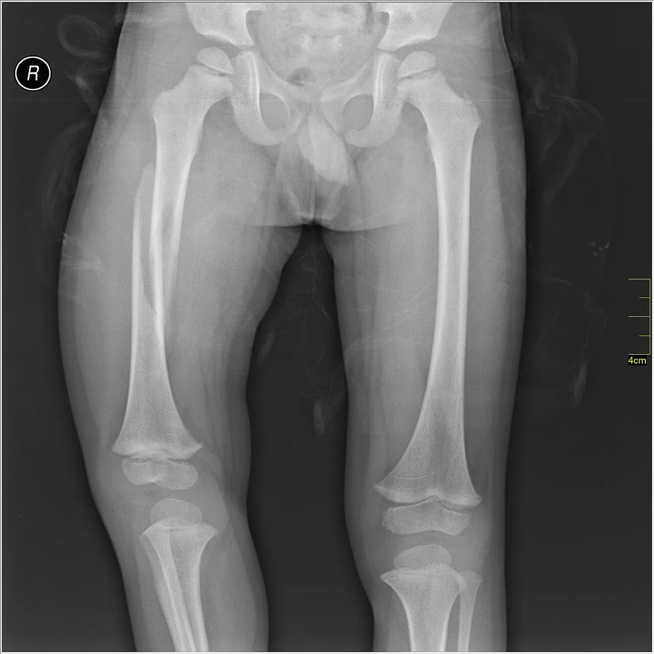 Lower limb radiograph for self-assessment
