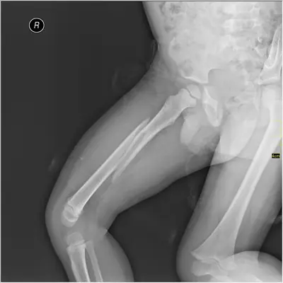 Radiograph from the case bank: Femoral shaft fracture