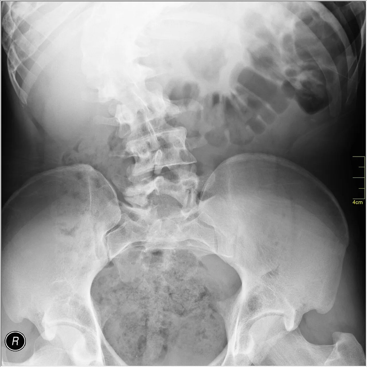 Spine radiograph for self-assessment