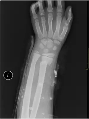 Radiograph from the case bank: Distal radius fracture