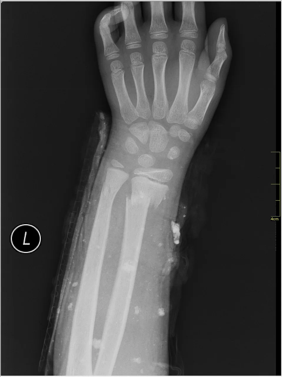 Upper limb radiograph for self-assessment