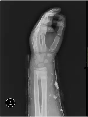 Radiograph from the case bank: Distal radius fracture