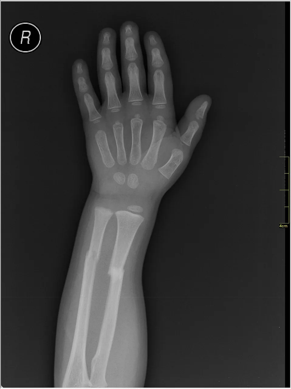 Upper limb radiograph for self-assessment