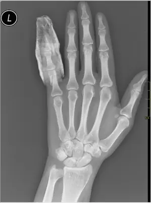 Radiograph from the case bank: Finger (phalangeal) fracture