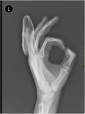 Radiograph from the case bank: Finger (phalangeal) fracture