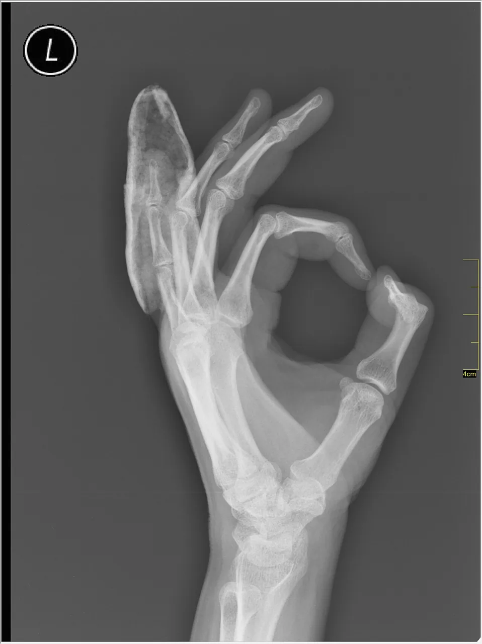 Upper limb radiograph for self-assessment