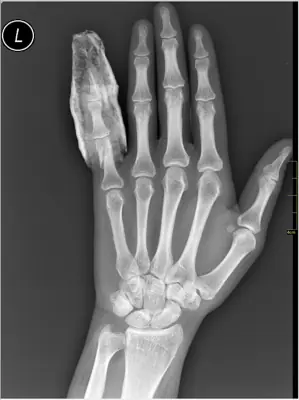 Radiograph from the case bank: Finger (phalangeal) fracture