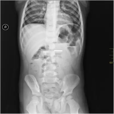Radiograph from the case bank: Foreign body (ingested or inserted)