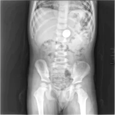 Radiograph from the case bank: Foreign body (ingested or inserted)