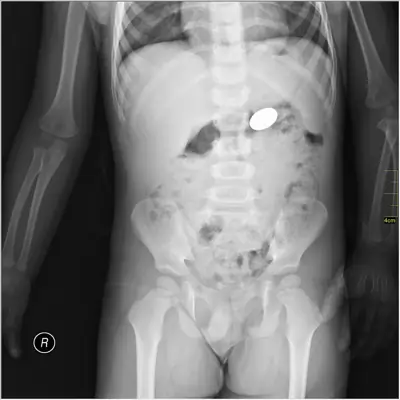 Radiograph from the case bank: Foreign body (ingested or inserted)