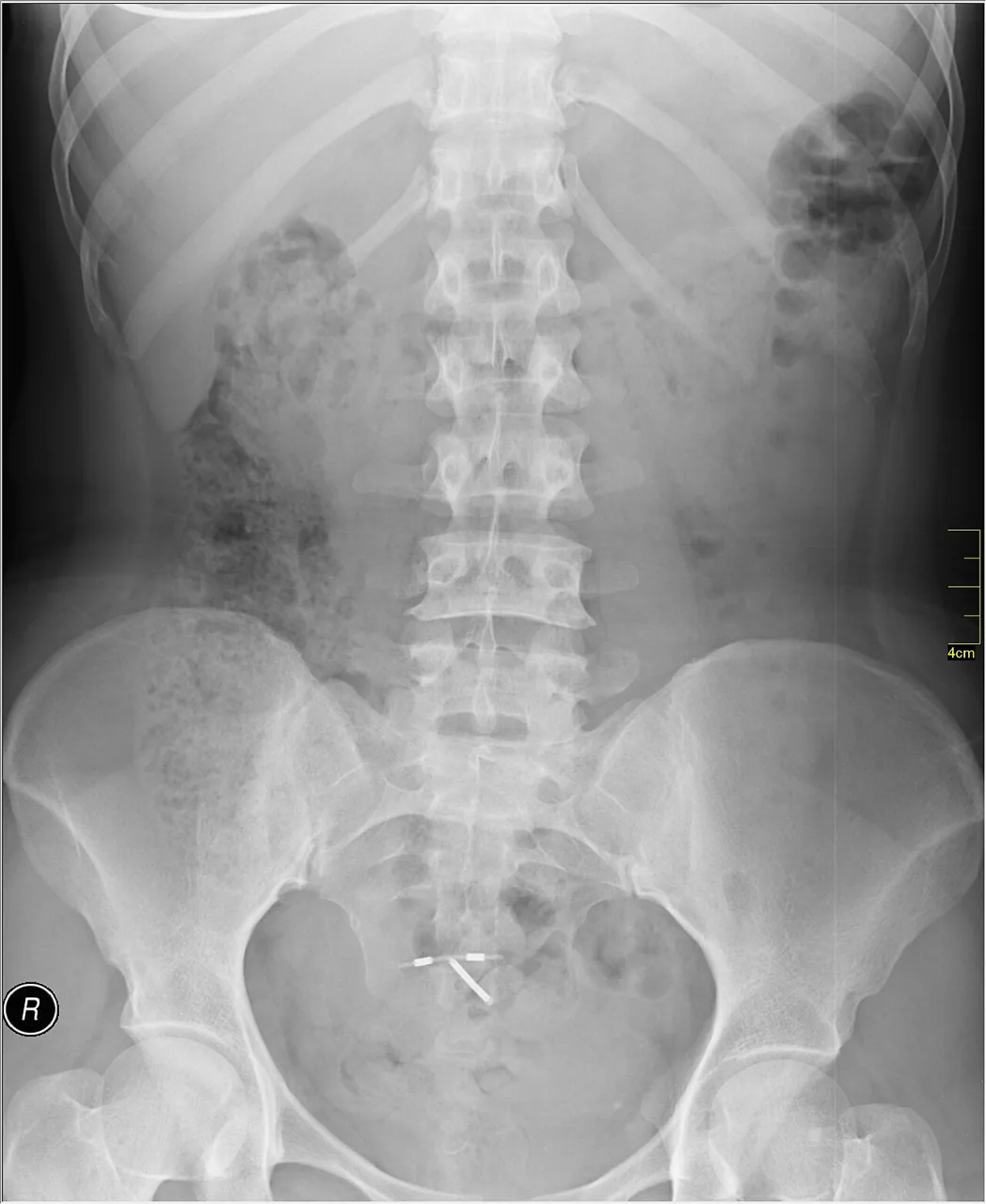 Abdomen radiograph for self-assessment