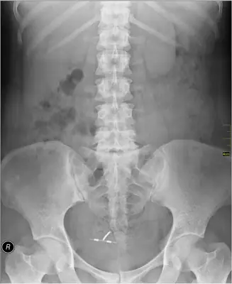 Radiograph from the case bank: Intrauterine contraceptive device (IUCD)