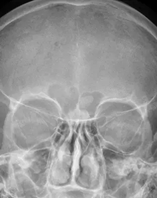 Radiograph from the case bank: Osteoma