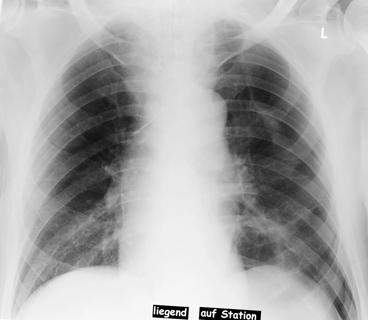 Chest radiograph for self-assessment