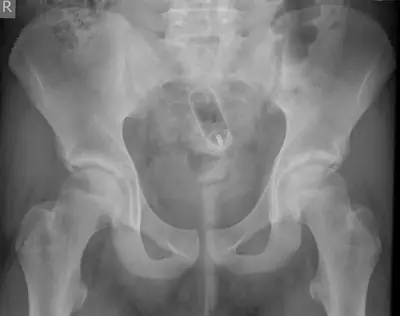 Radiograph from the case bank: Foreign body (ingested or inserted)