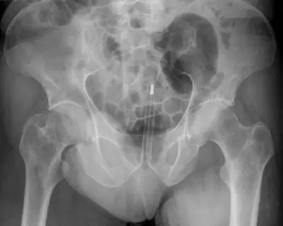 Radiograph from the case bank: Foreign body (ingested or inserted)
