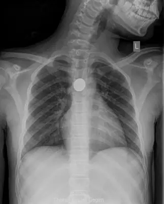 Radiograph from the case bank: Foreign body in the oesophagus