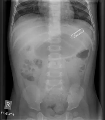 Radiograph from the case bank: Foreign body (ingested or inserted)