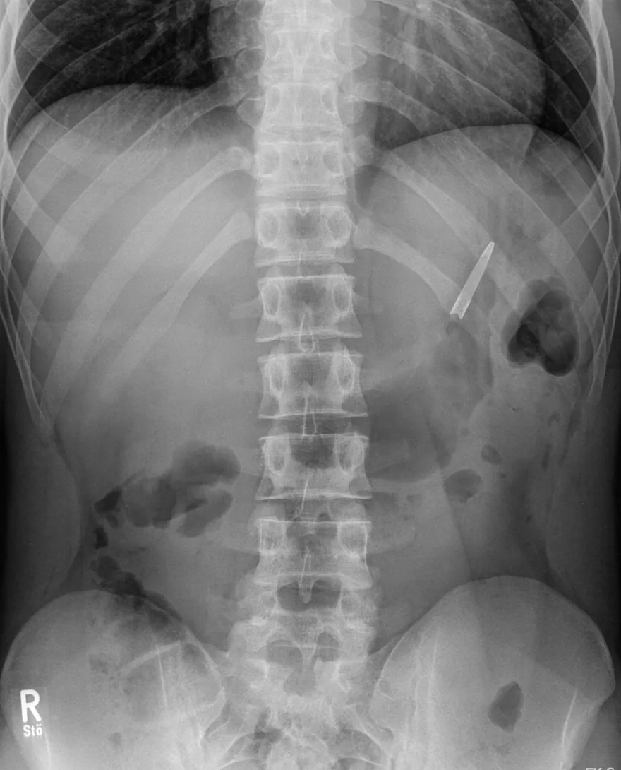 Abdomen radiograph for self-assessment