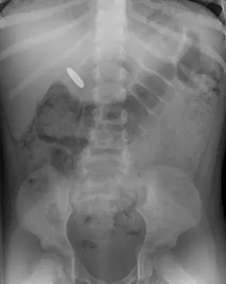Radiograph from the case bank: Foreign body (ingested or inserted)