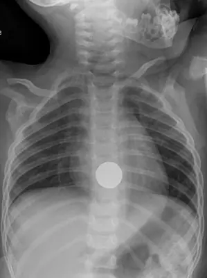 Radiograph from the case bank: Foreign body in the oesophagus