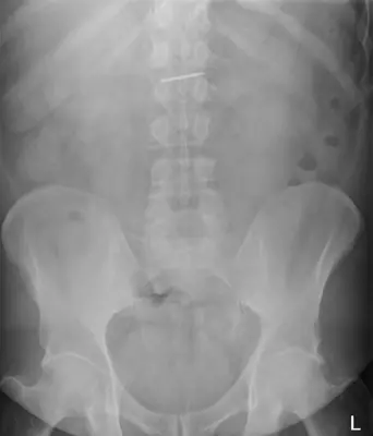 Radiograph from the case bank: Foreign body (ingested or inserted)