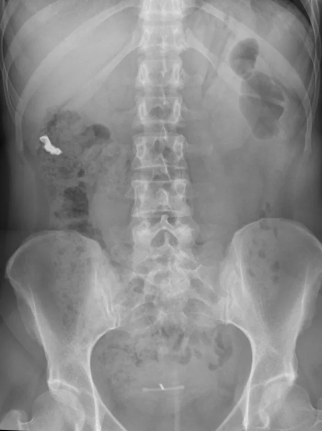 Abdomen radiograph for self-assessment