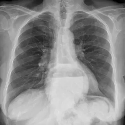 Radiograph from the case bank: Hiatus hernia