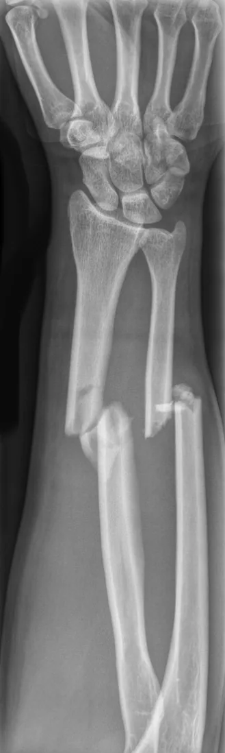 Upper limb radiograph for self-assessment