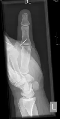 Radiograph from the case bank: Finger (phalangeal) fracture