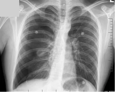 Radiograph from the case bank: Pneumothorax